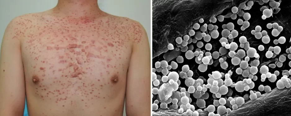 Similarities between Keratosis Pilaris and Folliculitis